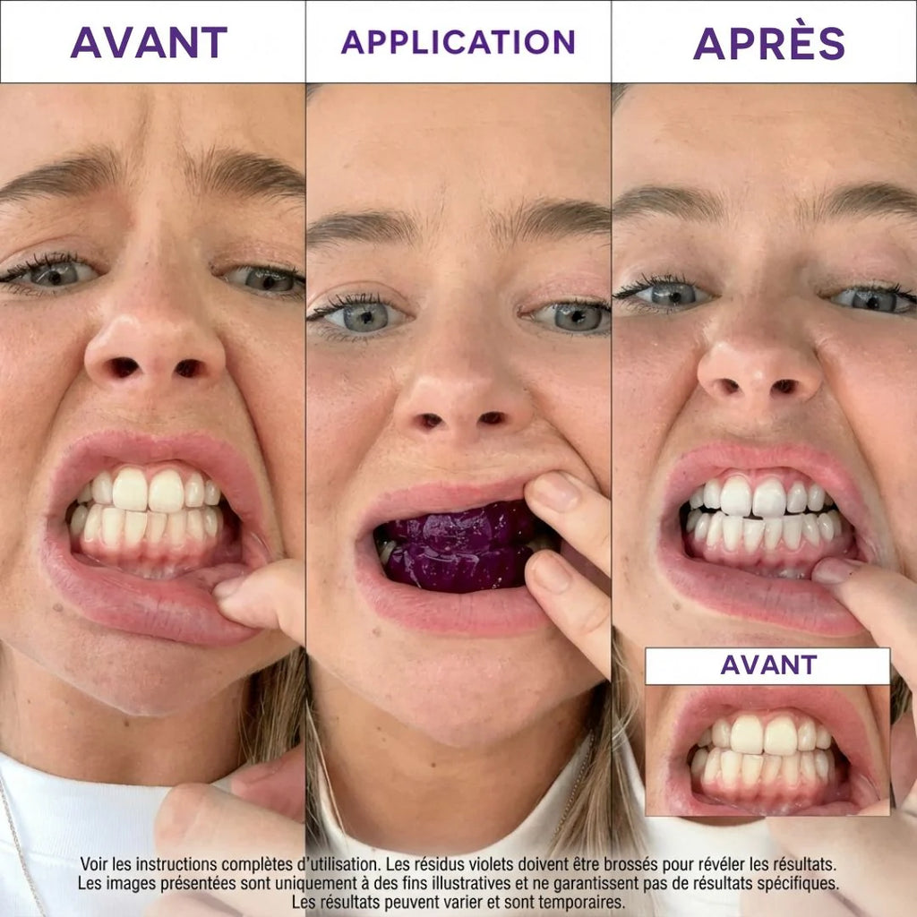Bande pour blanchissement dentaire ultra rapide
